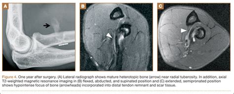 Dynamic Magnetic Resonance Imaging Of Partial Thickness Retearing Of