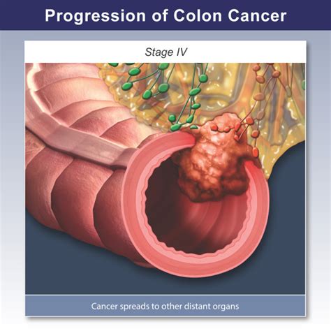 Stage Iv Colon Cancer Trial Exhibits Inc