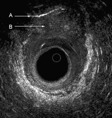 Endoluminal Ultrasound | Abdominal Key