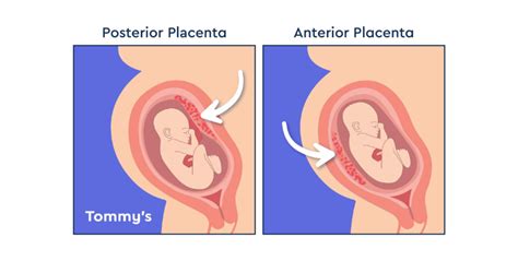 Anterior Vs Posterior Placenta Dr Asha Susawat