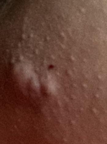 Crazy Cyst On My Upper Inner Thigh It Popped And A Tooooon Of Blood