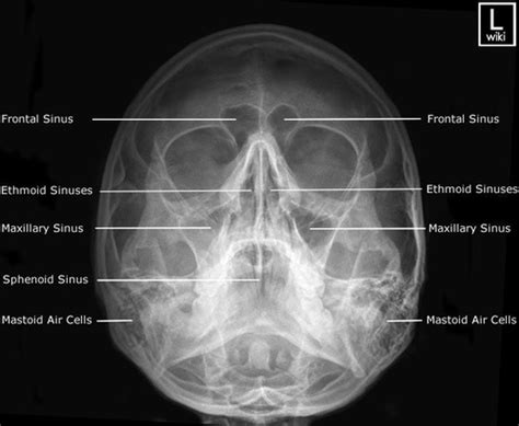 Paranasal Sinuses Flashcards Quizlet