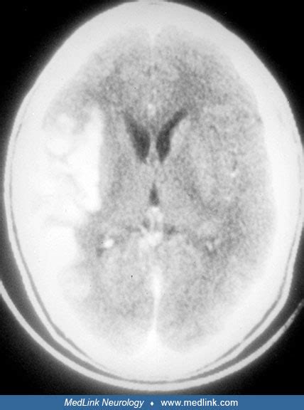 Neurosyphilis Medlink Neurology