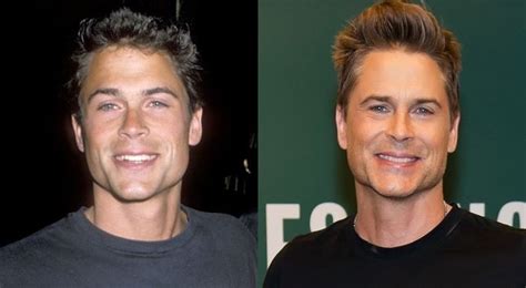 Rob Lowe Before And After Plastic Surgery 19 Celebrity Plastic