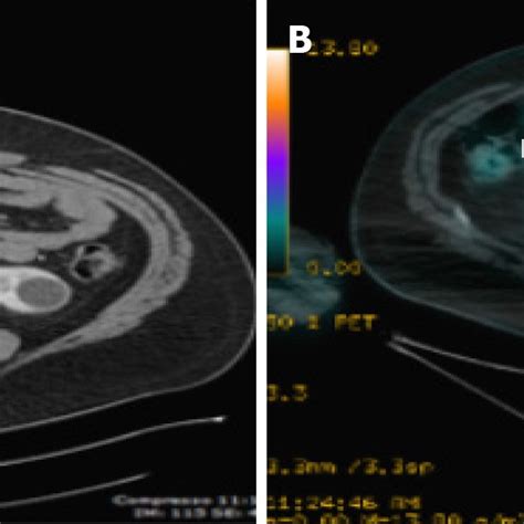 Positron Emission Tomography Computed Tomography Images Showing