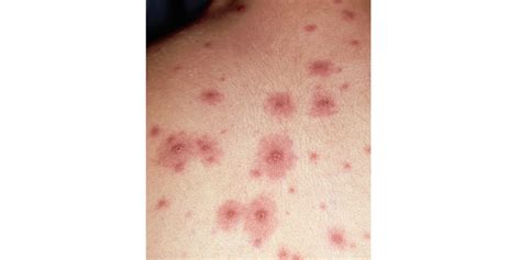 10 Common Rashes Skin Chart