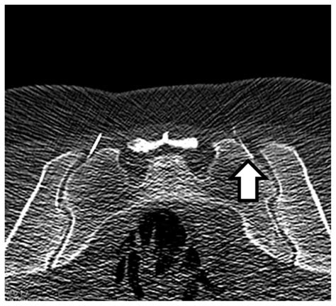 Bilateral Ct Guided Si Joint Injection In Low Dose Protocol Download