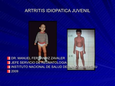 Situación Actual De La Artritis Idiopática Juvenil