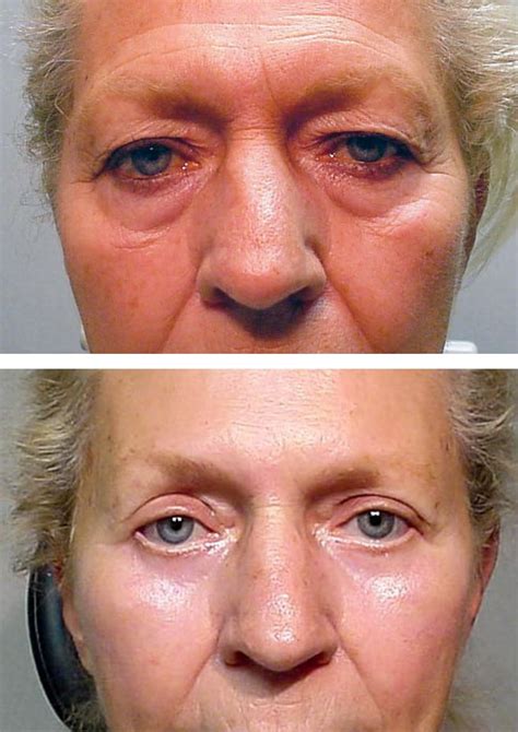 Upper Blepharoplasty Gone Wrong