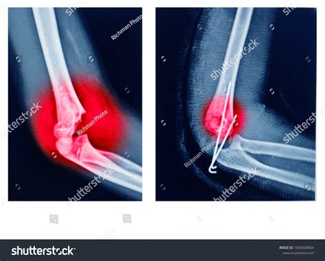 Xray Elbow Showing Supracondylar Humerus Fracture Stock Photo Edit Now