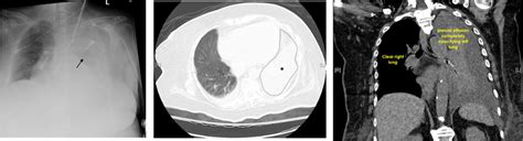 Ap Chest Radiograph And Axial And Saggital Views Of Chest Ct