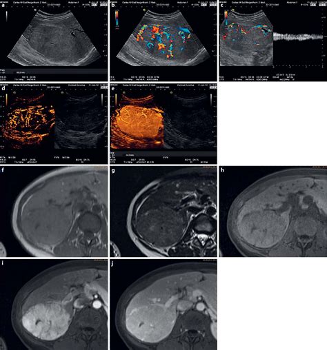 Figure 3 From Advantages And Limitations Of Focal Liver Lesion