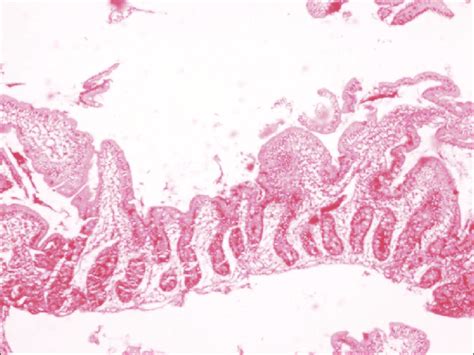 Duodenal Biopsy Showing Shortening And Flattening Of Villi H And E ×10 Download Scientific