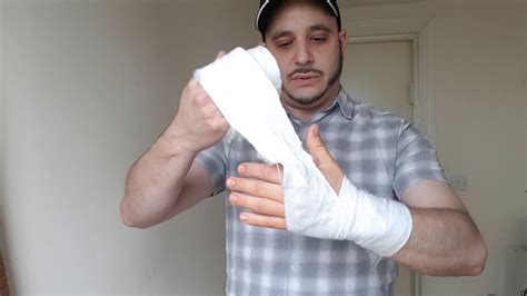 2 Days After Carpal Tunnel Surgery Bandage Removal Youtube