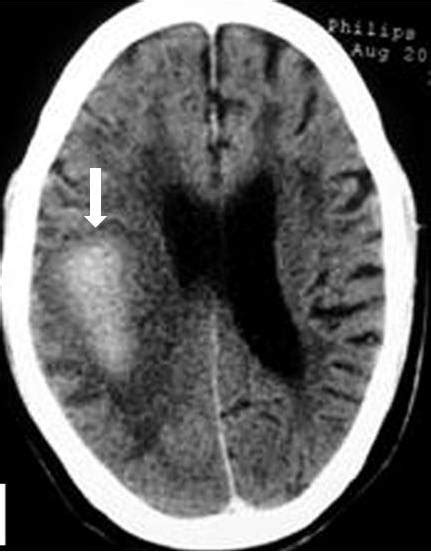 Cerebral Amyloid Angiopathy Intechopen