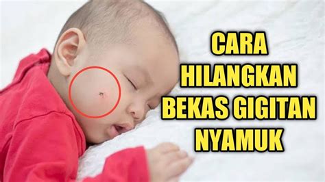 Cara Cepat Menghilangkan Bekas Gigitan Nyamuk Pada Bayi YouTube