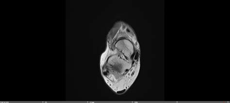 Posterior Tibial Tendinosis — Chicago Foot & Ankle Orthopaedic Surgeons