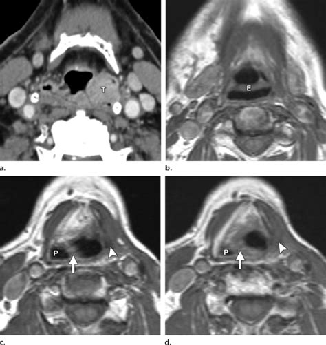 Stage T2 Piriform Sinus Carcinoma In A 70 Year Old Patient A Axial