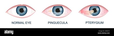 Eye Healthy With Pinguecula And Pterygium Growing Onto Cornea