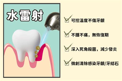 水雷射無痛治療牙周病，怕痛不用瑟瑟發抖 新竹品味牙醫