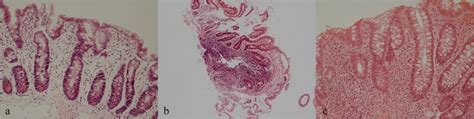 A Duodenum With Villous Atrophy Increased Intraepithelial Lymphocytes