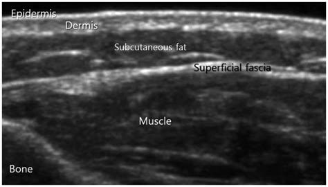 Ultrasonography Of Pediatric Superficial Soft Tissue Tumors And Tumor