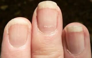 Lines on nails vitamin deficiency - Awesome Nail