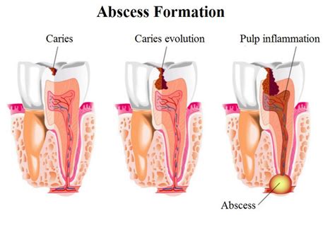 Understanding The Condition Of Tooth Abscess D4 Dentist