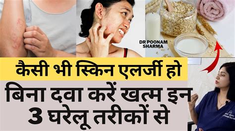 स्किन एलर्जी के 3 घरेलु इलाज। Urticaria Ka Ilaaj Home Remedies For Skin Allergy Youtube