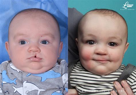 Cleft Lip Repair Primary Unilateral Before And After Photos Law