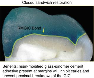 The Benefits And Limitations Of Glass Ionomer Cements And Their Use In