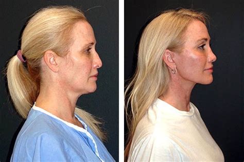 Mini Facelift Best Mini Facelift Procedure In New York