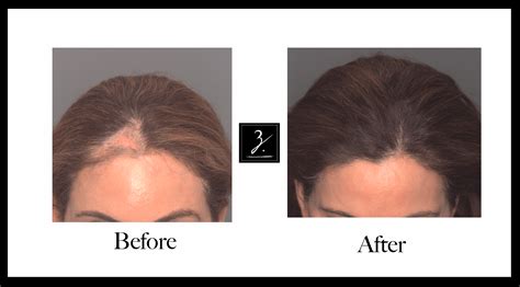 Hair Transplant Before And After