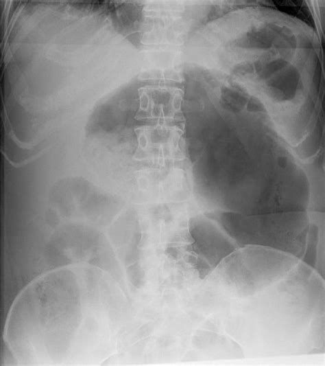 volvulus radiology cecal volvulus   teenaged patient  journal