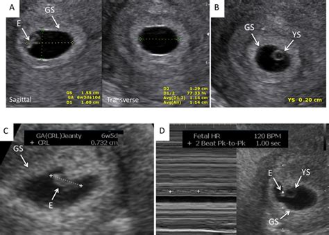 Early Pregnancy Ultrasound Measurements And Prediction Of First