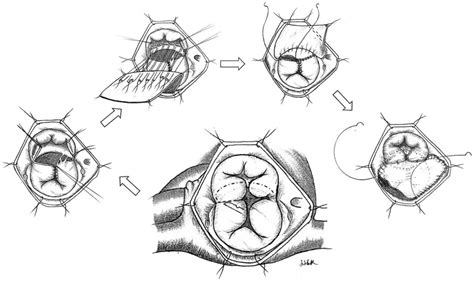 The V Shaped The American Association For Thoracic Surgery AATS