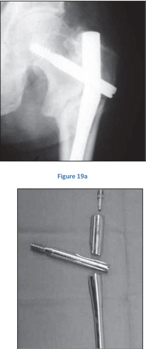 Pdf Prise En Charge Des Fractures Per Trochant Riennes Instables Par