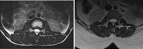 Axial plane of T2W showing ligamentum flavum hypertrophy at L3 | Download Scientific Diagram