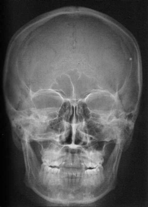 Radiologia Posicionamento Da Face