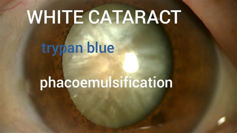 Simple White Cataract Surgery Trypan Blue Staining Youtube