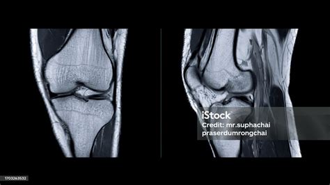 Magnetic Resonance Imaging Of Knee Joint Or Mri Knee Sagittal For