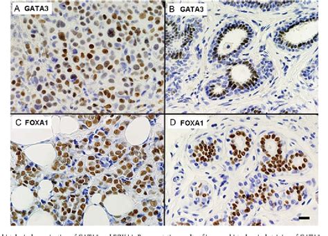 Figure 1 From Clinicopathological Analysis Of GATA3 Positive Breast