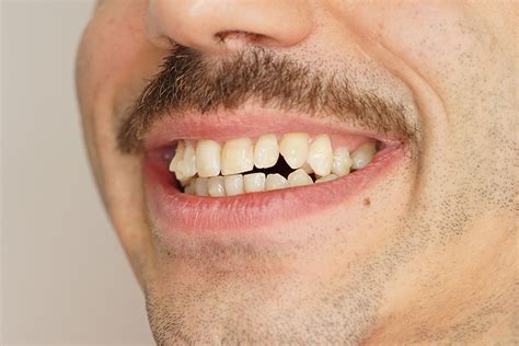 Ataches Invisalign Qué son cómo funcionan y su importancia