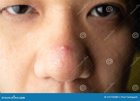 Acne On The Nose And Black Spots Caused By Melasma Royalty Free Stock