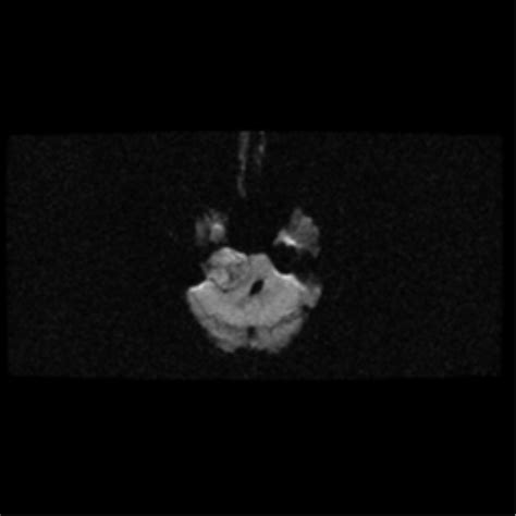 Acoustic Schwannoma Eroding Petrous Apex Image Radiopaedia Org