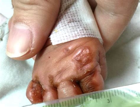 Transient Zinc Deficiency Dermatitis In A Very Low Birth Weight Preterm