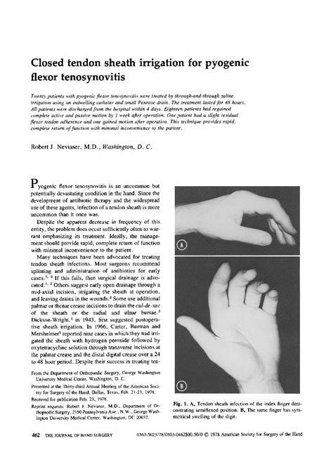 Pdf Closed Tendon Sheath Irrigation For Pyogenic Flexor Tenosynovitis