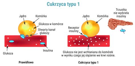 Cukrzyca Typu 1 Diabetmed Pl