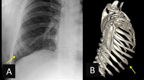 Radiology Of Ribs Spectrum Of Normal Variants And Pathological