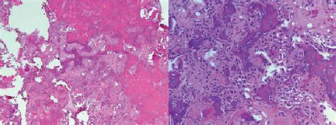 Low And High Power Histologic Representation Of Intraoperative Biopsy